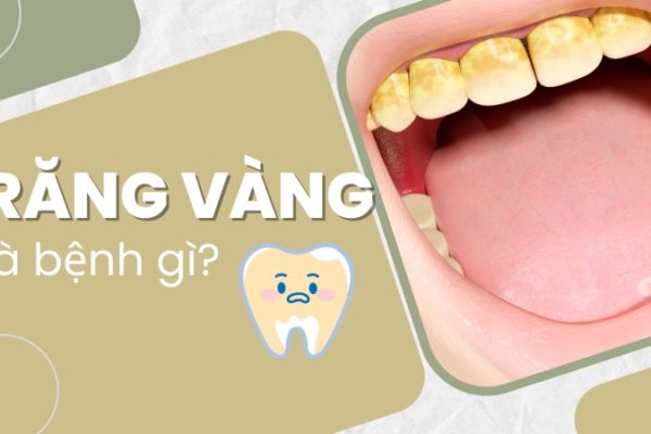 Răng vàng là bệnh gì? Điều trị hết bệnh có giúp răng trắng lại? Răng vàng là bệnh gì? Điều trị hết bệnh có giúp răng trắng lại?