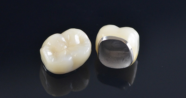 Bọc răng sứ kim loại có tốt không và có bị đen chân răng không?