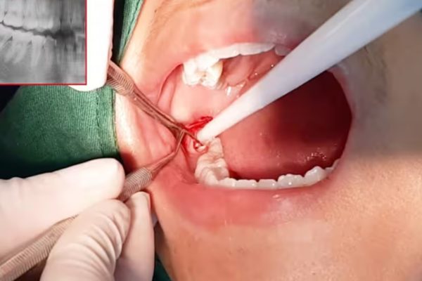 Độ tuổi nào là tốt nhất để nhổ răng khôn? Độ tuổi nào là tốt nhất để nhổ răng khôn?