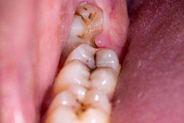 Có nên nhổ răng khôn ngay khi nó bắt đầu nhú không? Có nên nhổ răng khôn ngay khi nó bắt đầu nhú không?