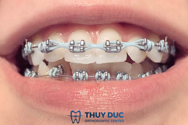 Tìm hiểu 15 loại khí cụ phổ biến trong chỉnh nha Tìm hiểu 15 loại khí cụ phổ biến trong chỉnh nha