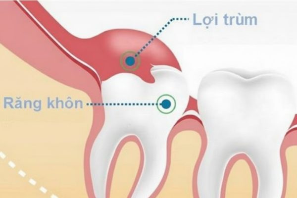 Có thể nhổ răng khôn khi đang bị đau, sưng, viêm không? Có thể nhổ răng khôn khi đang bị đau, sưng, viêm không?