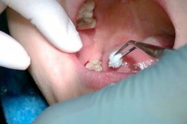 Có nên nhổ nhiều răng khôn cùng lúc không? Có nên nhổ nhiều răng khôn cùng lúc không?