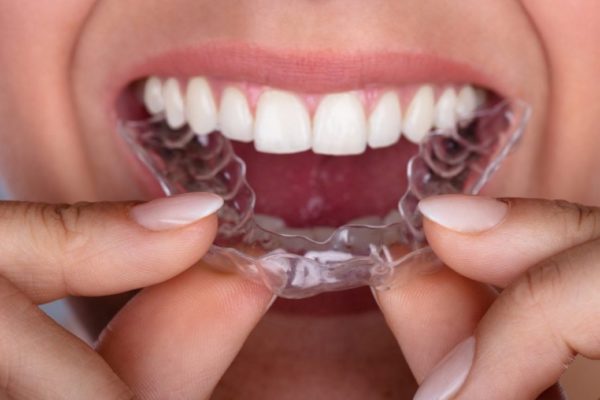 Niềng răng Invisalign có thực sự hiệu quả không? Niềng răng Invisalign có thực sự hiệu quả không?