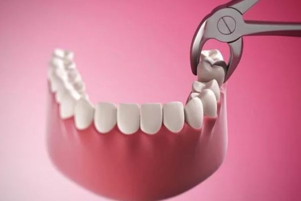 Niềng răng Invisalign có cần nhổ răng không?