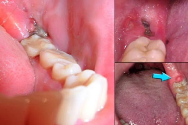 Các biến chứng thường gặp sau khi nhổ răng khôn hàm dưới