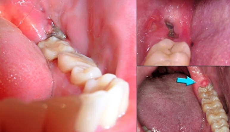 Các biến chứng thường gặp sau khi nhổ răng khôn hàm dưới