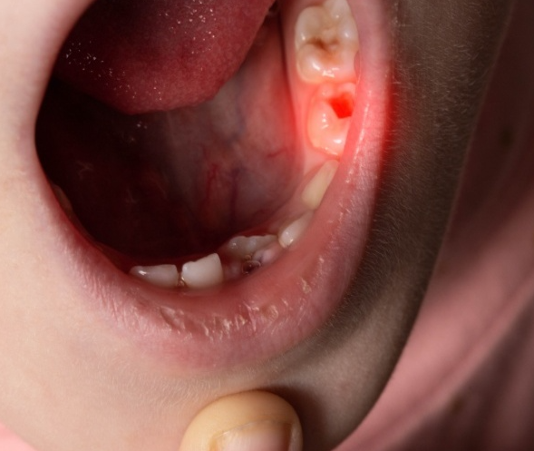 Rủi ro khi nhổ răng sai thời điểm