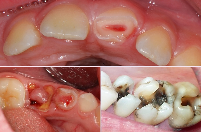 Hậu quả khi không điều trị răng sâu