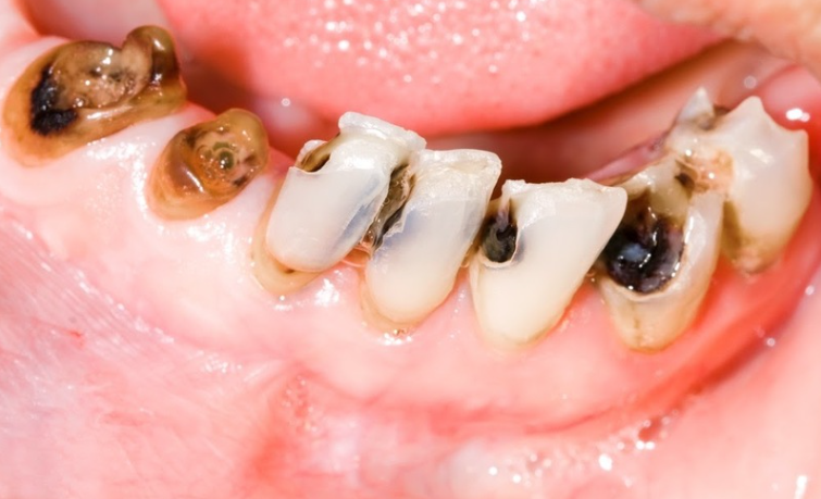 Thời điểm bắt buộc phải nhổ răng sâu