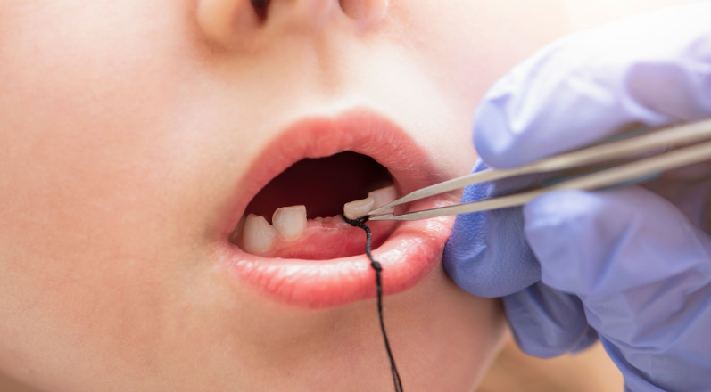 Khi nào cần nhổ răng sữa