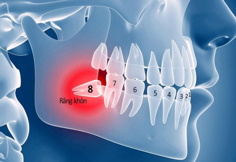 Rủi ro khi nhổ nhiều răng khôn cùng lúc