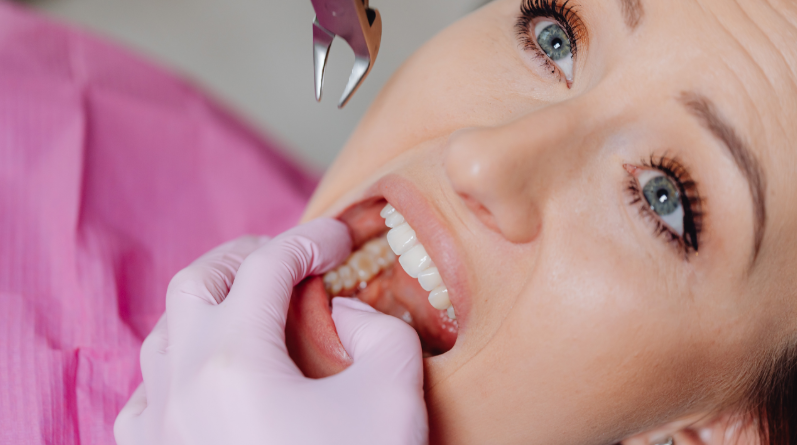 Thủ thuật nhổ 4 răng khôn cùng lúc