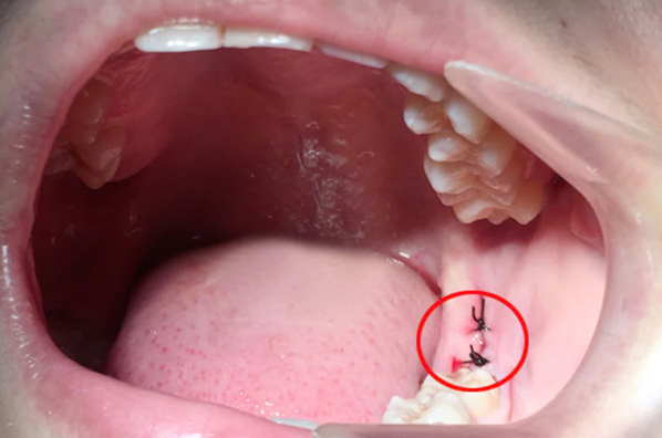 Nhổ răng khôn có phải khâu không?