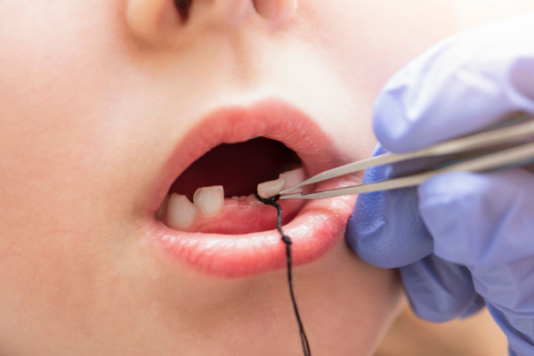 Nhổ răng sữa chưa lung lay có để lại biến chứng không? Nhổ răng sữa chưa lung lay có để lại biến chứng không?