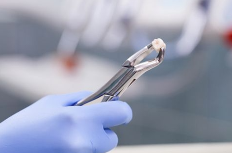 Nhổ răng sữa cho bé tại nha khoa