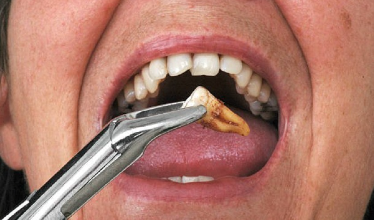 Quy trình thực hiện nhổ răng sâu chuyên nghiệp