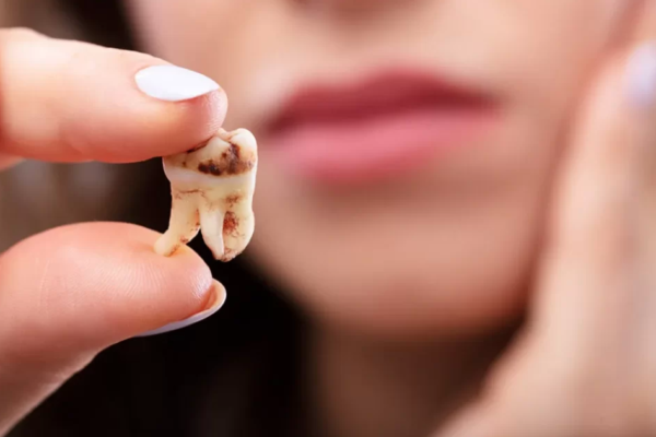 Có răng sâu mà không nhổ thì có sao không?