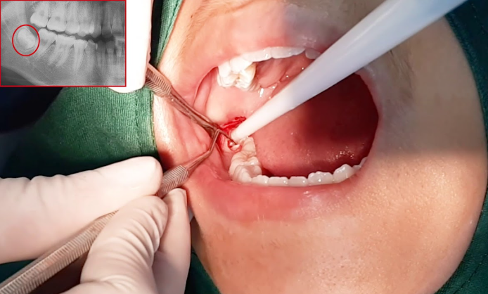 Biến chứng khi nhổ răng sai thời điểm