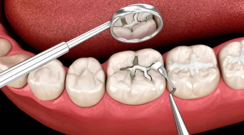 So sánh trám và nhổ răng sữa