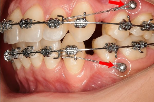 Cắm vít khi niềng răng là gì? Cắm vít có đau không?