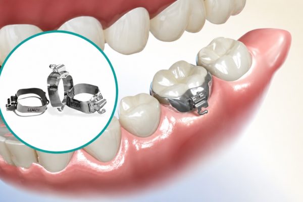 Ai cần gắn Band niềng răng? Gắn Band niềng răng bao lâu?