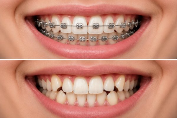 Chạy răng sau niềng răng phải làm sao? Chạy răng sau niềng răng phải làm sao?