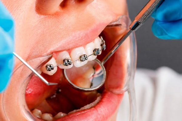 Chỉnh nha là gì? Hiểu tường tận các phương pháp chỉnh nha Chỉnh nha là gì? Hiểu tường tận các phương pháp chỉnh nha