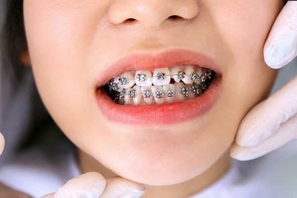 Có nên niềng khi niềng răng cho trẻ 6 tuổi?