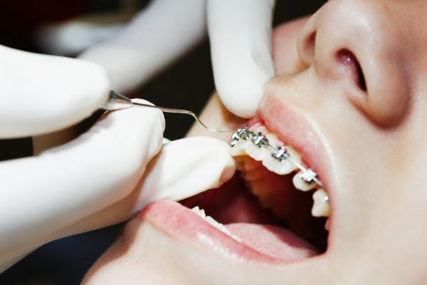 Có nên tháo niềng răng sớm không? Có nên tháo niềng răng sớm không?