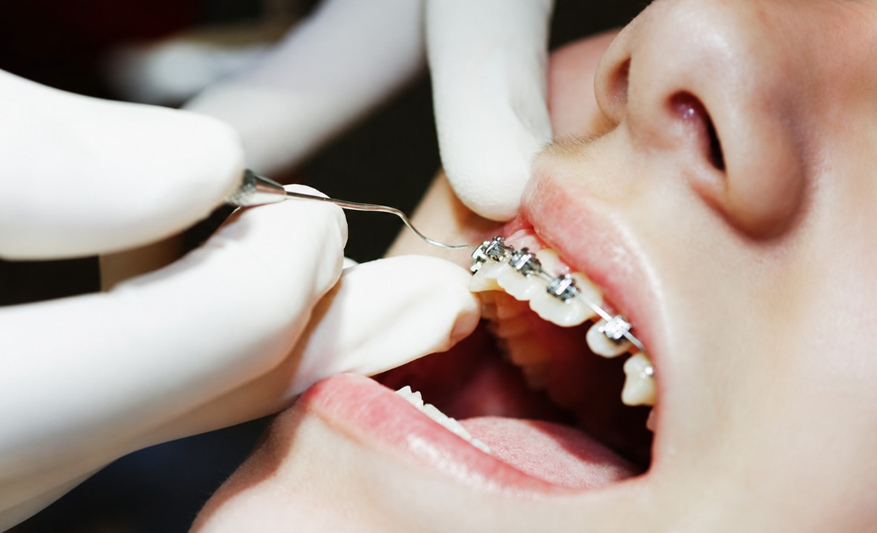 Có nên tháo niềng răng sớm không