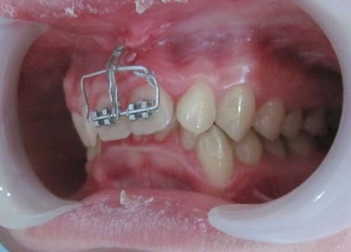 Đánh lún răng – nguyên lý và đối tượng nên thực hiện Đánh lún răng – nguyên lý và đối tượng nên thực hiện