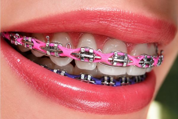 Các loại dây thun cần có khi niềng răng