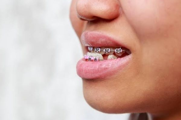 Hàm răng dưới chìa ra ngoài phải làm sao để khắc phục?