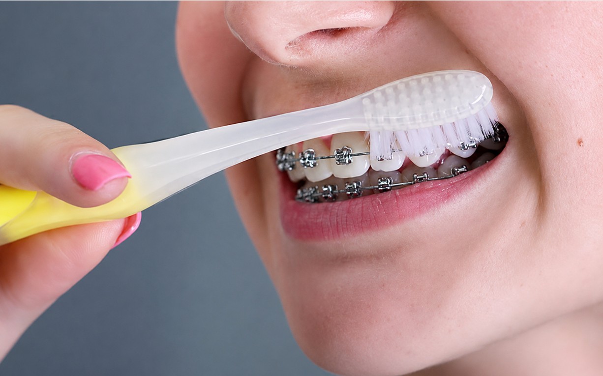 Các trường hợp cân nhắc tháo niềng sớm