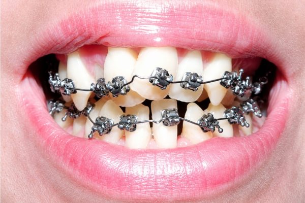 “Niềng răng hỏng” không đến bất ngờ – Đây là cách nhận biết từ sớm “Niềng răng hỏng” không đến bất ngờ – Đây là cách nhận biết từ sớm