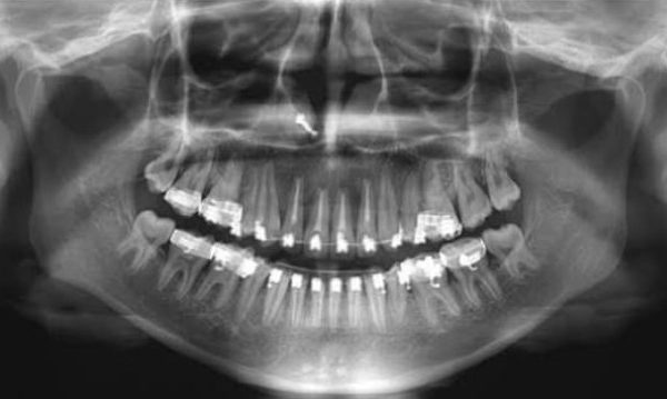 Giải đáp chi tiết: Răng đã lấy tủy có niềng được không? Giải đáp chi tiết: Răng đã lấy tủy có niềng được không?