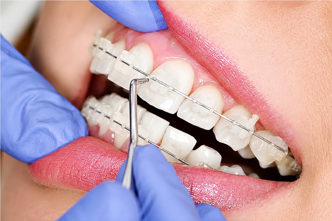 Ưu điểm của mắc cài sứ tự buộc