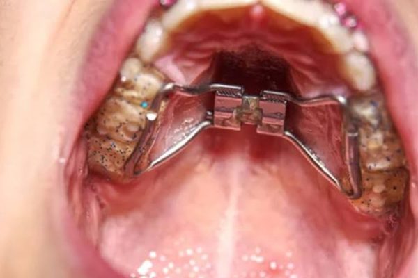 Điều trị khớp cắn ngược ở trẻ nhỏ như thế nào? Điều trị khớp cắn ngược ở trẻ nhỏ như thế nào?