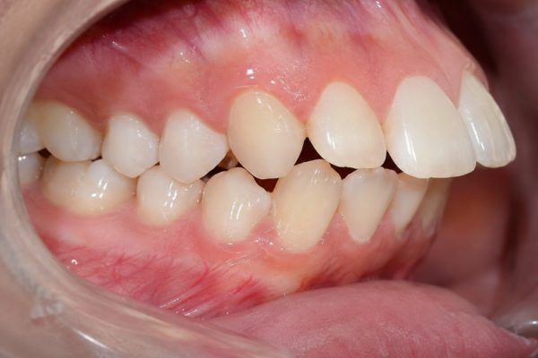 Chi phí niềng răng hô hiện nay là bao nhiêu? Cập nhật báo giá mới nhất