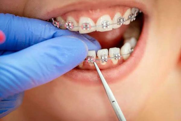 Dây cung niềng răng – công dụng và câu hỏi thường gặp Dây cung niềng răng – công dụng và câu hỏi thường gặp