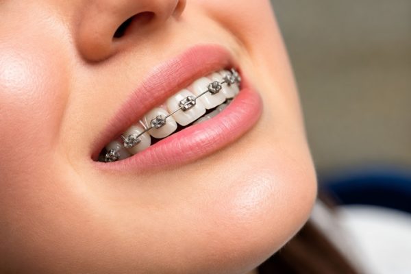 7 cách đẩy nhanh tiến độ niềng răng bạn cần biết 7 cách đẩy nhanh tiến độ niềng răng bạn cần biết