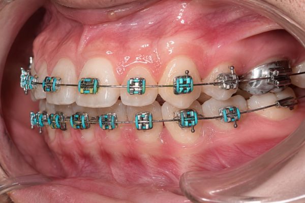 Đau răng khi gắn band niềng răng có sao không? Nên làm gì? Đau răng khi gắn band niềng răng có sao không? Nên làm gì?
